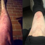 Before treatment of psoriasis and after 8 sessions in NovoTHOR pod