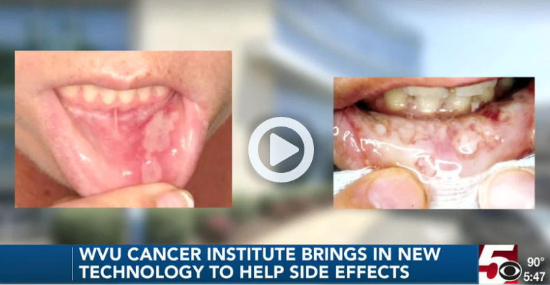 WVU Cancer Institute brings new technology to help with a common side effect