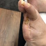 Diabetic foot ulcer 5th pic